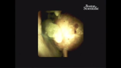 Single Session EHL for Large Bile Duct Stones, by Neil Sharma, MD & Colin Linke, MS4