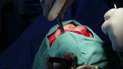 Autologous Chondrocyte Implantation (ACI) and the Future of Cartilage Restoration at the Penn Cartilage Center