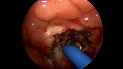 Mount Sinai Otolaryngology Surgical Series: Adenoidectomy