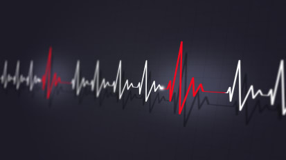 Noninvasive Cardiac RadioAblation: Using Focused Radiation