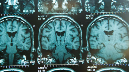 Deep Brain Stimulation (DBS) for Movement Disorders