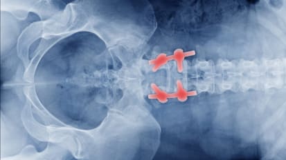 Complex Spine Surgery: Secrets of Successful Closure 