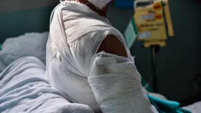 Piel de cerdo como alternativa de cobertura cutánea en pacientes quemados – Experiencia en República Dominicana