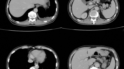 Coronary Artery Calcification: A Journey from the CT Lab to Primary Prevention Guidelines