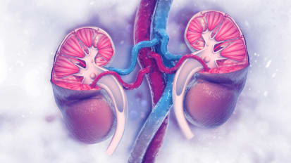 Kidney Stone Disease Q&A