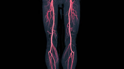 Optimizing care with laser atherectomy in advanced peripheral arterial disease