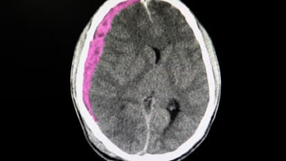 Advanced Care of Subdural Hematoma in the Elderly: A Look at Embolization