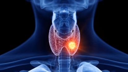 Incidental Thyroid Nodules: Benign Bump or Big Deal?