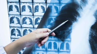 Low Dose CT Scans for High Risk Patients