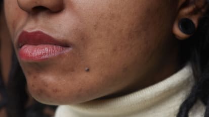 All About Acne (and Other Pustular Problems): Better Management of Skin Conditions