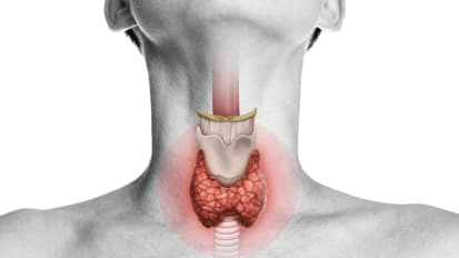 Radiofrequency Ablation: A New Option for Benign Thyroid Nodules