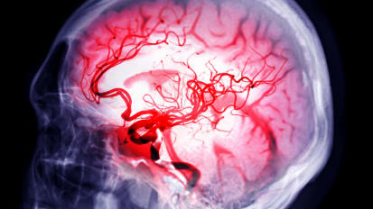 Anticoagulation Following Ischemic Stroke and Intracranial Hemorrhage