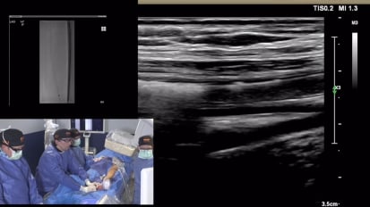 Fighting CLI: Imaging and treatment algorithm