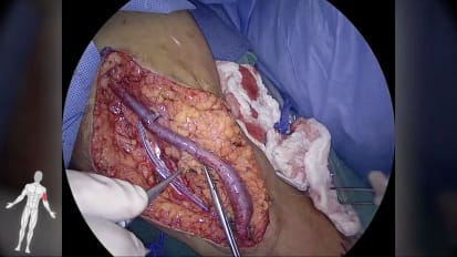 Arteriovenous Fistula (AVF) Superficialization 