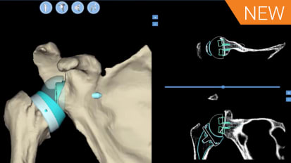 3D Virtual Planning for a Severely Retroverted Glenoid with Brent Morris, MD [AP-010167A]