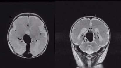 Neuroendovascular Embolizations to Cure Vein of Galen Malformations