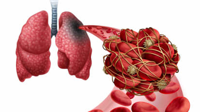 Acute Pulmonary Embolism – Massive PE – IR Perspective