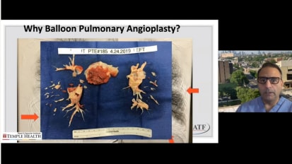 Balloon Pulmonary Angioplasty (BPA) Overview