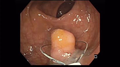 Endoscopic Mucosal Resection Case by Dr Neil Sharma, of Parkview Health Fort Wayne, IN