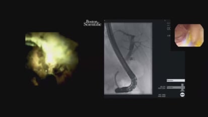 Managing a Difficult Cystic Duct Stone using Cholangioscopy with EHL, by George Webster, MD, University College London Hospitals, London, UK