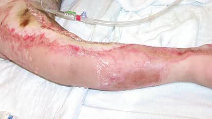 Burns 102: Escharotomy for 3rd Degree (Full-Thickness) Burns