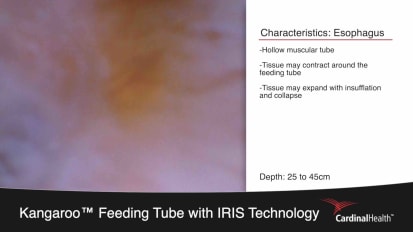 Narrated Placement B: Kangaroo™ Feeding Tube with IRIS Technology