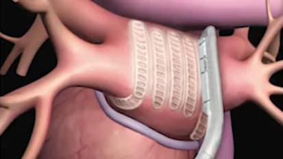 Clinical Minutes: Recent Advances in Atrial Fibrillation Treatment