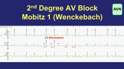 Telemetry Tips Part 2: Mobitz 1 Block vs. Mobitz 2 Block
