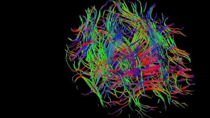 Cutting-edge treatment and research for brain tumors