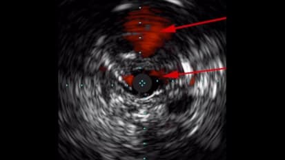 IVUS Pioneer Plus