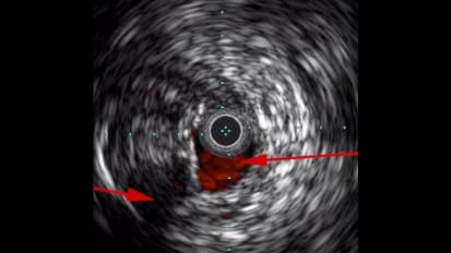 IVUS Pioneer Plus