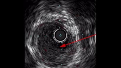 IVUS Pioneer Plus