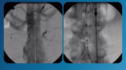 Case Study: EVAR with IVUS as presented by Dr. Michael Turchek