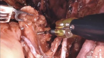 Day 1: Robot-Assisted Radical Cystoprostatectomy with Bilateral Lymph Node Dissection<br>Part 2: Pelvic Lymph Node Dissection