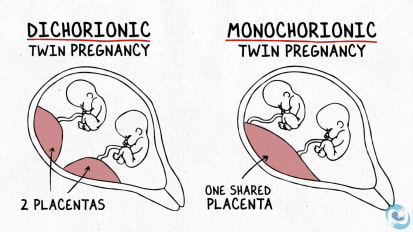 The Difference Between Dichorionic and Monochorionic Twins