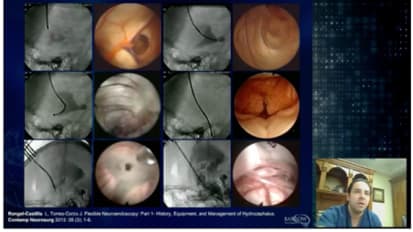 Neuroendoscopy-Flexible endoscopy-Leonardo Rangel-Castilla, MD