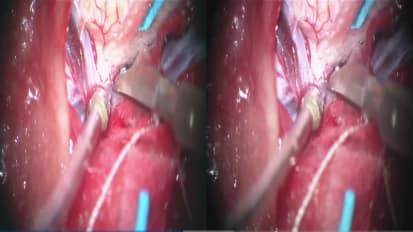 Focused Transsylvian Approach for a Left Posterior Insular Cavernous Malformation: 3D Operative Video