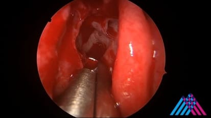 Mount Sinai Otolaryngology Surgical Series: Functional Endoscopic Sinus Surgery (FESS) for Sinusitis