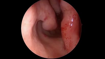 Coblation Treatment for HHT Nosebleeds