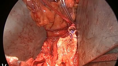 Open Aorta Right Iliac Anastomosis Case - Part 3 of 4