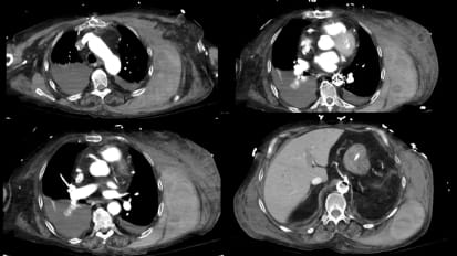 Embolization of a Bleeding Intercostal Artery