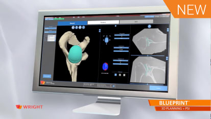 How BLUEPRINT™ Works – from CT to 3D [CAW-9389]