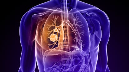 Lung Cancer Screening: The Development of Guidelines and Policy 