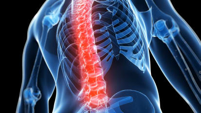 Comparing Surgical Approaches to Treat Spinal Synovial Cysts