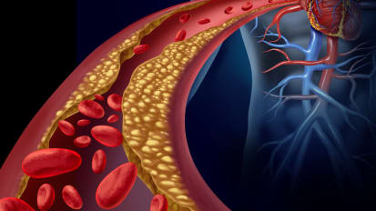 The Role of Advanced Surgical Therapies for Massive Pulmonary Embolism