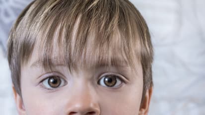 Pediatric Cataracts: Diagnosis, Treatment and Future Implications