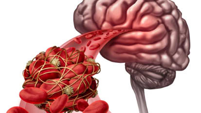 Microsurgery for Bilateral Supratentorial Aneurysms