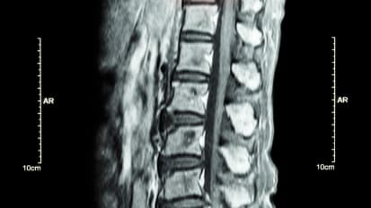 Ali Bydon Removes an Intradural Spinal Cord Tumor