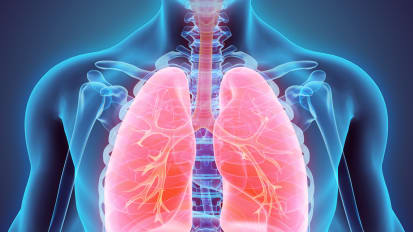 Recurrent Respiratory Papillomatosis