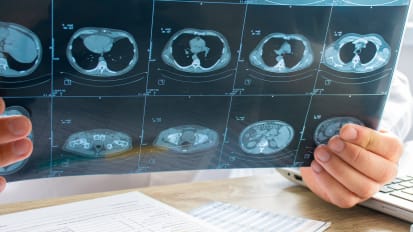 The importance of lung cancer screening